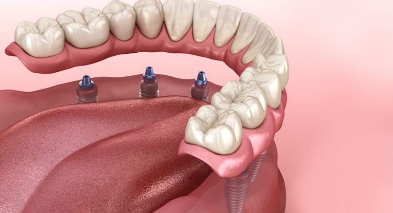 بدلة أسنان ثابتة على زراعة الأسنان في عيادة الأسنان جراح أسنان ألفا دكتور يونس دكاني الجزائر العاصمة بالجزائر