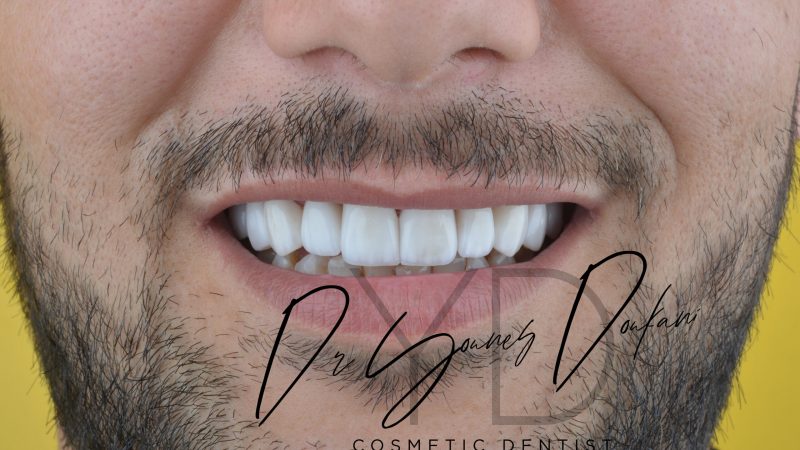 Facettes Dentaires​ - British Dental