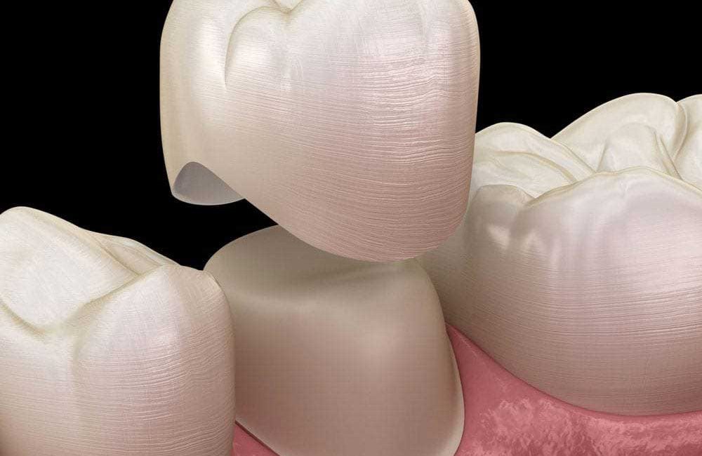 Implant dentaire avec prothèse dentaire, c'est quoi une couronne dentaire composants d'un implant dentaire chirurgien dentiste spécialiste en implant dentaire et en couronne en Algérie à Alger centre