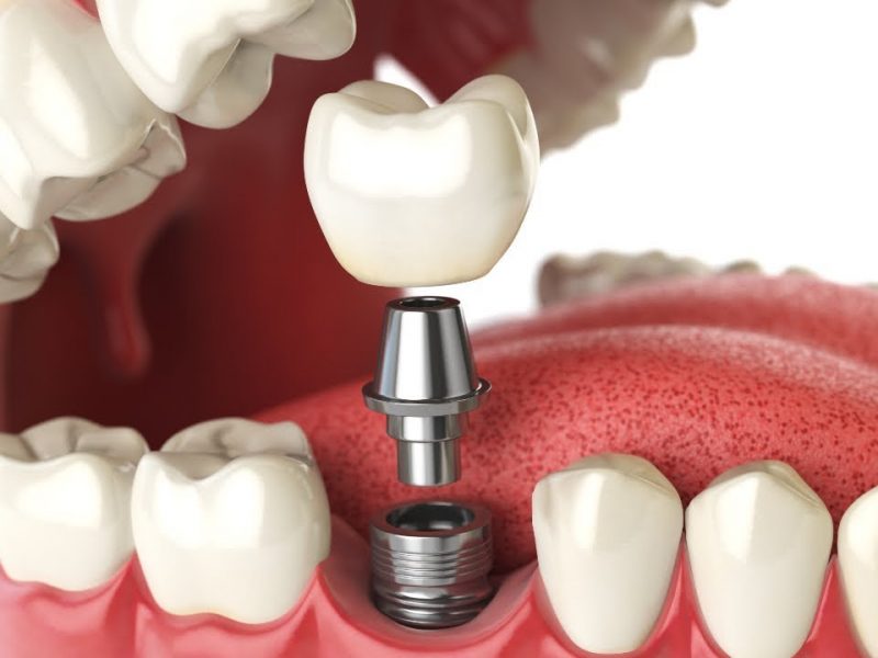 Dental implant components What is a dental implant components of a dental implant dental surgeon specialist in dental implant in Algeria in Algiers center