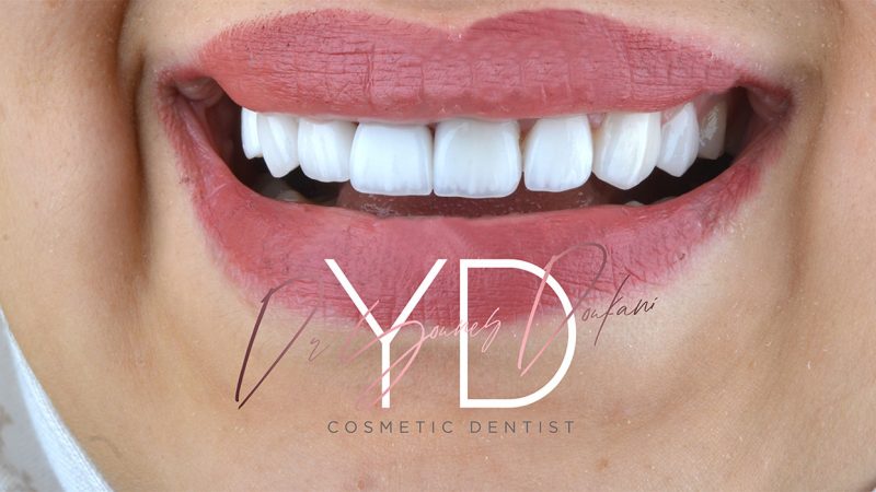 dental veneer and hollywood smile with perfect smile nnn veneers at the dental office alpha dental dental surgeon dr younes doukani Algiers in Algeria